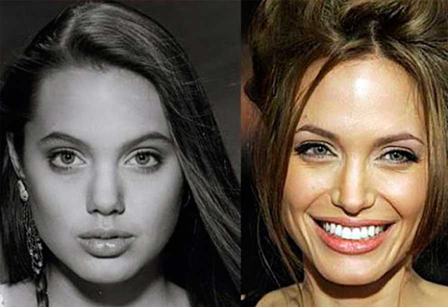 Angelina Jolie - Before and After Treatment photos