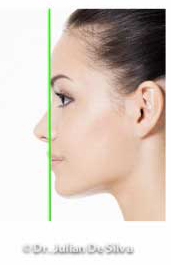 Woman's face, After Chin & Jaw Line Filler Enhancement, left side view