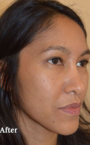 Non-Surgical Treatments After 1