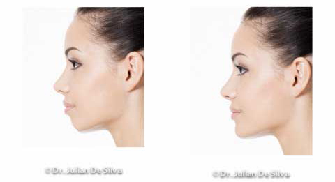 Woman's face, Before and After Chin & Jaw Line Filler Enhancement, left side view