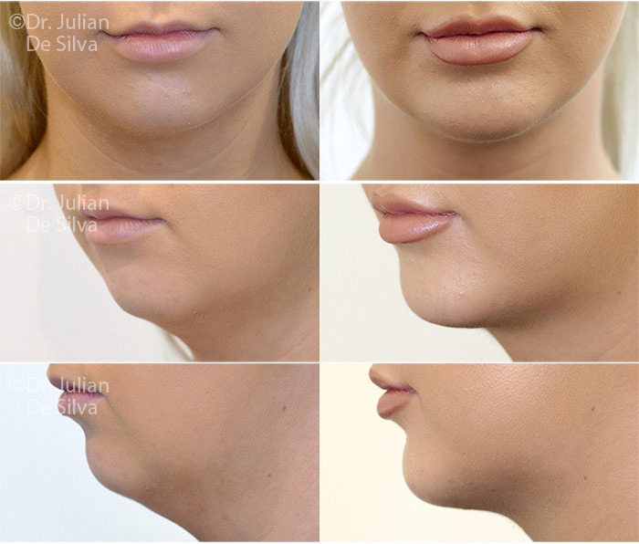 Woman's face, before and after chin implant, treatment photos, front,side,oblique face photos - female patient 1