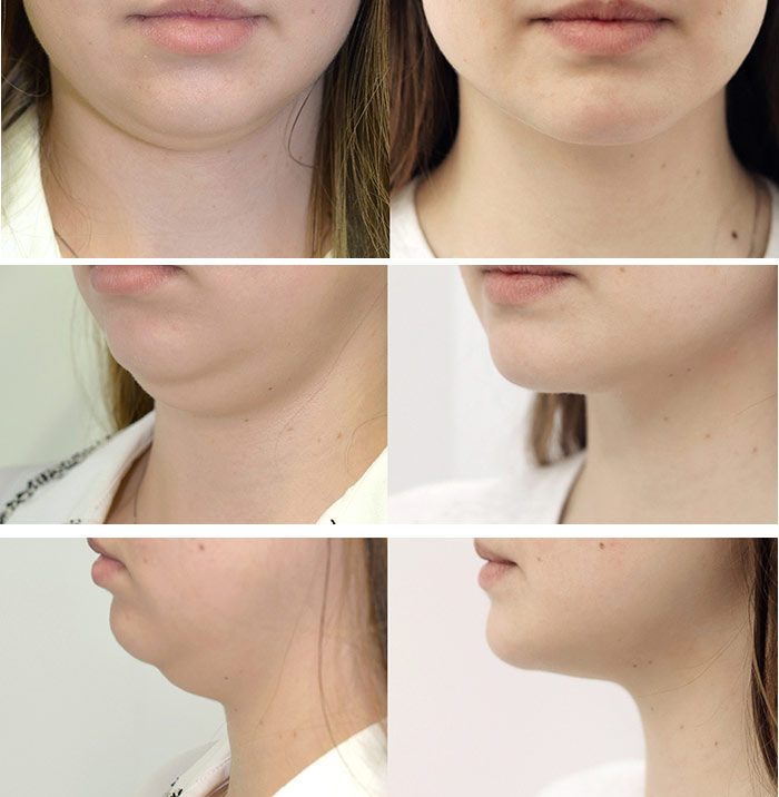 Woman's face, before and after chin implant, treatment photos, front,side,oblique face photos - female patient 1