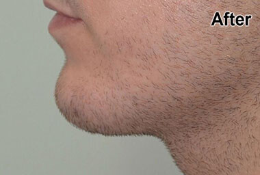 Non-Surgical Treatments After 2