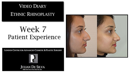Video Diary Ethnic Rhinoplasty Week 7 Patient Experience