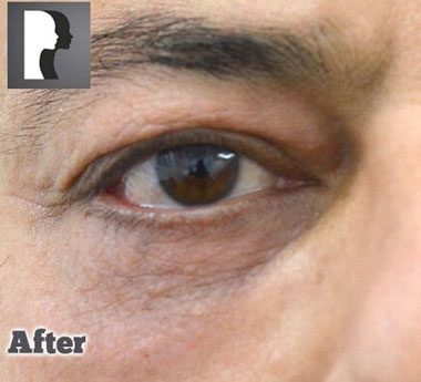 Non-Surgical Treatments After 5