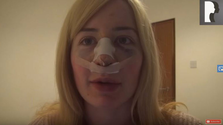 Video Diaries: Rhinoplasty (female)