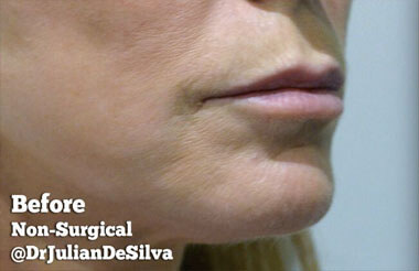 Non-Surgical Treatments Before 8