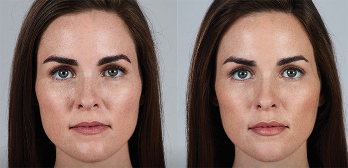 Woman's face, Before and After Lip Filler Enhancement, front view, patient 2