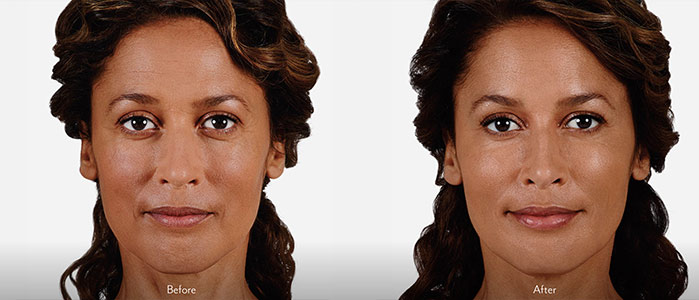 Woman's face, Before and After Lip Filler Enhancement, front view, patient 3