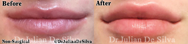 Before and After Lip Filler Enhancement, front view, patient 1