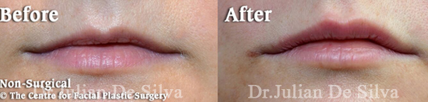 Before and After Lip Filler Enhancement, front view, patient 2
