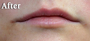 Non-Surgical Treatments After 4