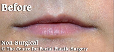 Non-Surgical Treatments Before 4