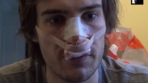 Video Diaries: Rhinoplasty (male)