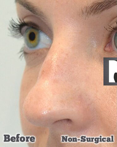 Non-Surgical Treatments Before 7