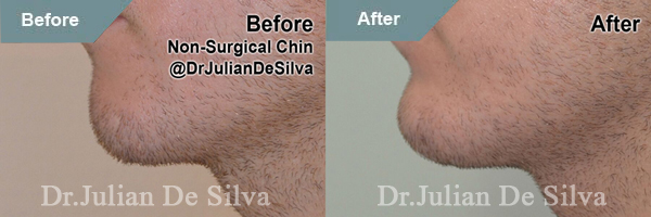 Male face, Before and After Chin & Jaw Line Filler Enhancement, left side view, patient 2