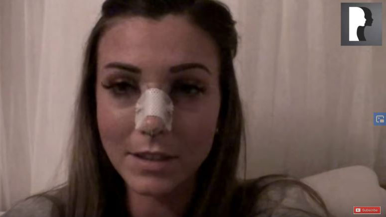 Video Diaries: caucasian woman in her 20s underwent rhinoplasty and septoplasty by Dr Julian De Silva