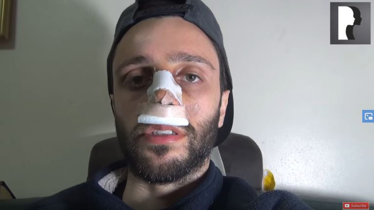 Video Diaries: middle eastern man in his 20s underwent rhinoplasty and septoplasty under sedation anaesthesia