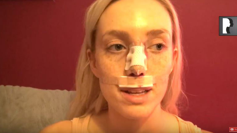 Video Diaries: patient who underwent Closed Rhinoplasty