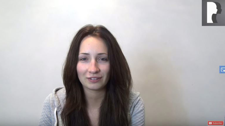 Video Diaries: caucasian woman in her 20s underwent rhinoplasty with a chin implant