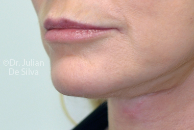 Skin & Laser Resurfacing After 1