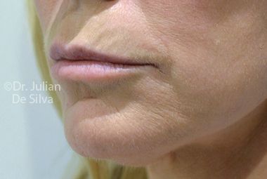 Skin & Laser Resurfacing Before 1