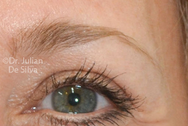 Skin & Laser Resurfacing After 2