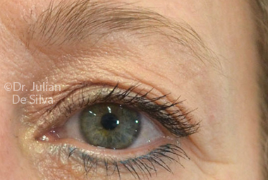 Skin & Laser Resurfacing Before 2