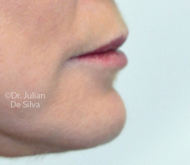 Skin & Laser Resurfacing After 3