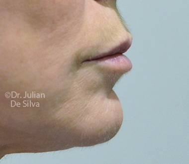 Skin & Laser Resurfacing Before 3