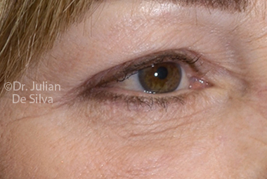 Skin & Laser Resurfacing After 4