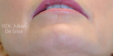 Skin & Laser Resurfacing After 5