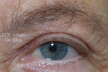 Skin & Laser Resurfacing After 6