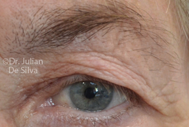 Skin & Laser Resurfacing Before 6