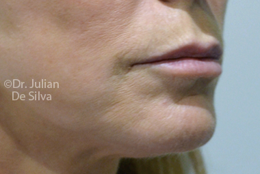 Skin & Laser Resurfacing Before 7