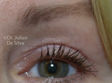 Skin & Laser Resurfacing After 8