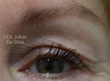 Skin & Laser Resurfacing Before 8