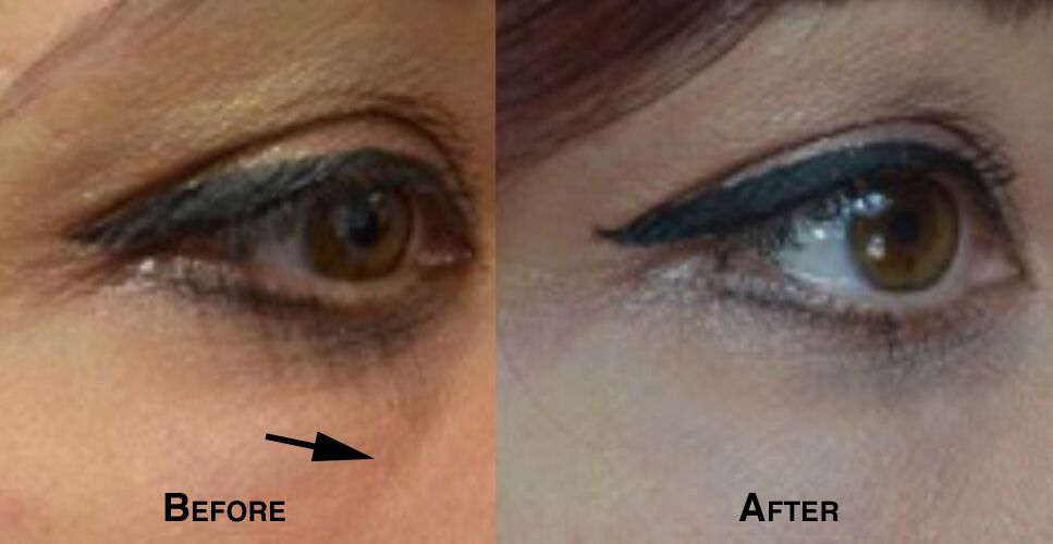 Woman's face, defore and after Lower Eyelid lift, parient 3