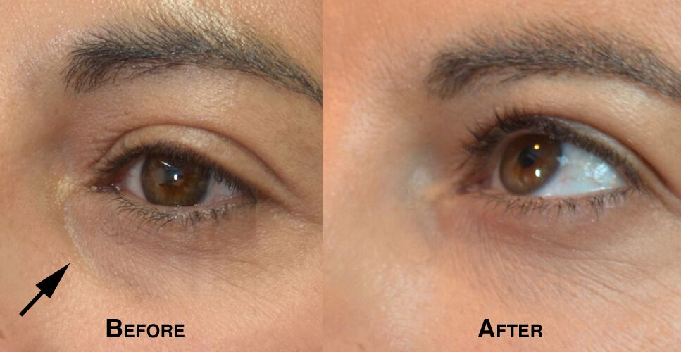 Woman's face, defore and after Lower Eyelid lift, parient 2