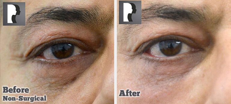 Male face, defore and after Lower Eyelid lift