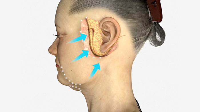 3d female face: recovering After Surgery, numbness around the ears and chin