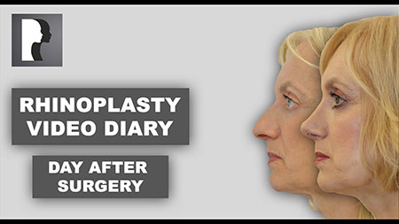 Rhinoplasty - video diary