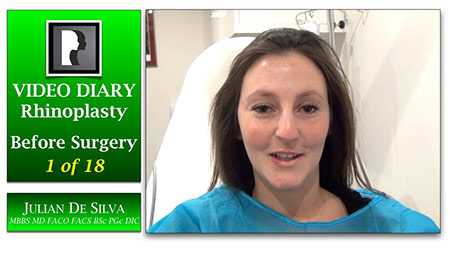 Rhinoplasty Video Diary (VD11)
