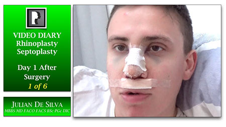 Rhinoplasty Video Diary (VD17)