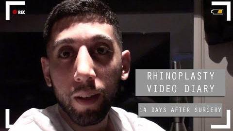 Rhinoplasty video diary - 14 days after surgery