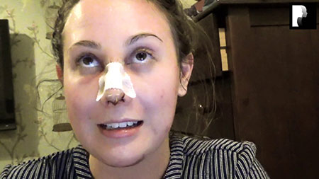 Chin Implant and Rhinoplasty Video Diary