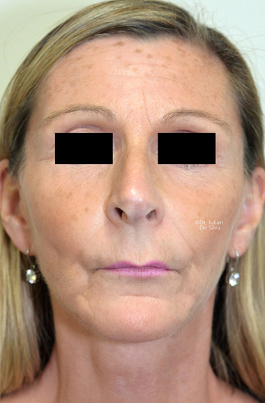 Non-Surgical Treatments After 11