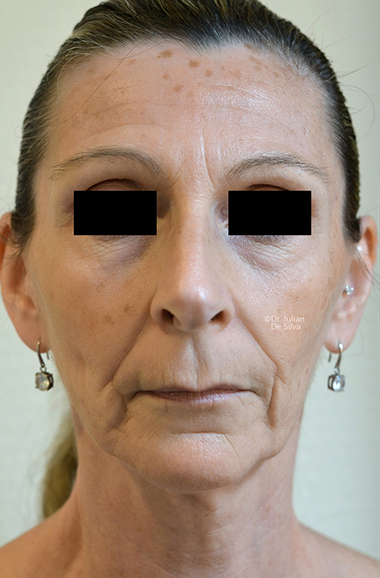 Non-Surgical Treatments Before 11