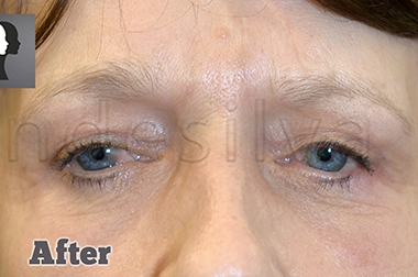 Non-Surgical Treatments After 12