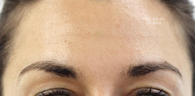 Non-Surgical Treatments After 13